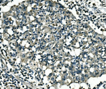 IHC staining of FFPE human lung cancer with PCTAIRE1 antibody. HIER: boil tissue sections in pH8 EDT