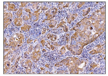 IHC staining of FFPE human gallbladder adenocarcinoma tissue with Deoxyhypusine synthase antibody. H