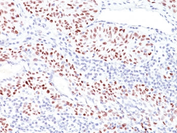 IHC: Formalin-fixed, paraffin-embedded human bladder carcinoma stained with TP53 antibody (TRP/816).