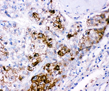IHC staining of FFPE human liver cancer tissue with CBS antibody. HIER: boil tissue sections in pH8 