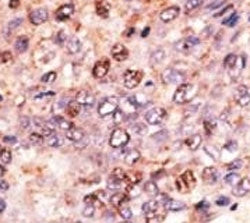 IHC analysis of FFPE human hepatocarcinoma tissue stained with the ABCB7 antibody
