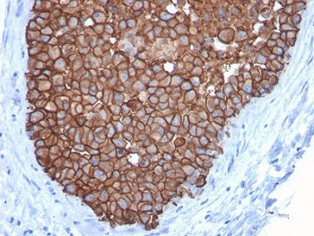 IHC staining of FFPE human breast carcinoma with HER2 antibody (clone ERBB2/3092). HIER: boil tissue