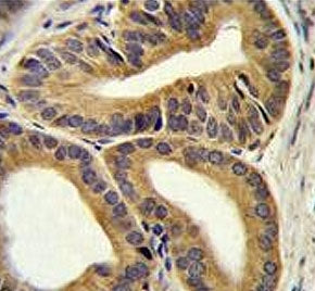 IHC testing of FFPE human prostate carcinoma tissue with TRIM65 antibody. HIER: steam section in pH6