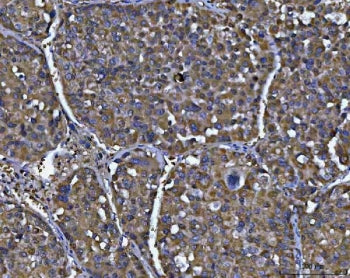 IHC staining of FFPE human liver cancer tissue with NIT2 antibody. HIER: boil tissue sections in pH8