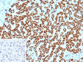 IHC staining of FFPE human hepatocellular carcinoma tissue with Carbamoyl phosphate synthetase 1 ant