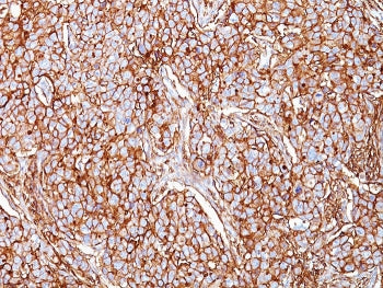 IHC: Formalin-fixed, paraffin-embedded human breast carcinoma stained with CD44 antibody (clone SPM5