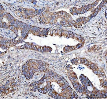 IHC staining of FFPE human colorectal adenocarcinoma tissue with MLEC antibody. HIER: boil tissue se