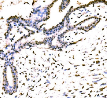 IHC staining of FFPE human breast cancer tissue with KIAA1429 antibody. HIER: boil tissue sections i