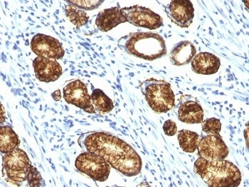 IHC: Formalin-fixed, paraffin-embedded human gastric carcinoma stained with Mucin-6 antibody (MUC6/9