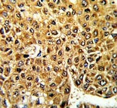 IHC testing of FFPE human hepatocellular carcinoma tissue with Max-like protein X antibody. HIER: st