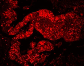 Immunofluorescent staining of FFPE human colon cancer tissue with MCM7 antibody. HIER: steam section