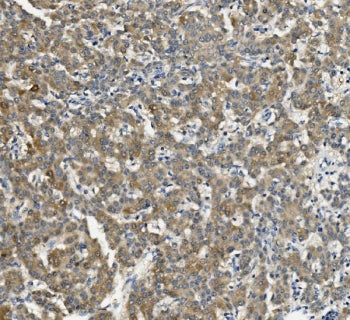 IHC staining of FFPE human liver cancer with CYP2C19 antibody. HIER: boil tissue sections in pH8 EDT