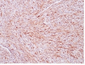 ALK Antibody / Anaplastic Lymphoma Kinase