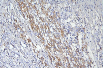 IHC staining of FFPE human liver cancer with CD46 antibody. HIER: boil tissue sections in pH8 EDTA f