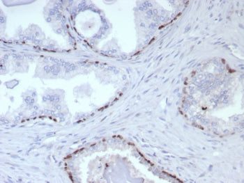 IHC staining of FFPE human prostate cancer tissue with p63 antibody (clone rP40/8765). HIER: boil ti