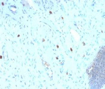 IHC staining of FFPE human cervix with recombinant HPV16 L1 antibody (clone HPV16/2058R). Required H