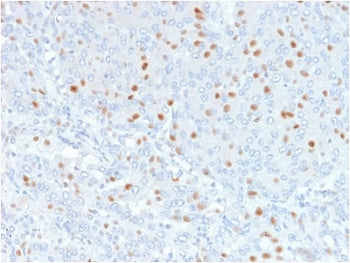 IHC testing of FFPE human bladder carinoma with Annexin A1 antibody (clone 6E4/3). HIER: boil tissue