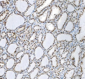 IHC staining of FFPE human thyroid cancer tissue with Nucleophosmin antibody. HIER: boil tissue sect