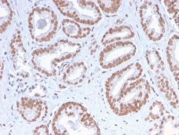 IHC staining of FFPE human prostate carcinoma with recombinant ATRX antibody. HIER: boil tissue sect