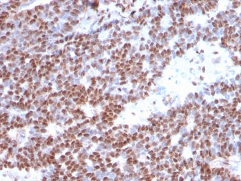 IHC staining of FFPE human breast carcinoma with Estrogen Receptor alpha antibody (clone ESR1/3373).