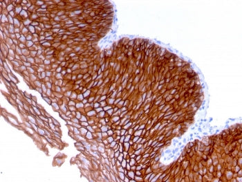 IHC staining of FFPE human esophageal carcinoma with Desmoglein 3 antibody (clone DSG3/2839). HIER: 