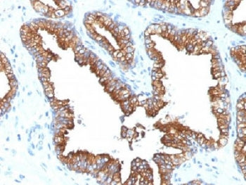 IHC analysis of FFPE human prostate carcinoma with Cytokeratin 8/18 antibody (clone KRT8.18/1346). R