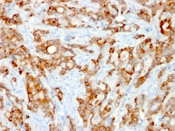 IHC testing of FFPE human lung carcinoma stained with recombinant Beta-2-Microglobulin antibody (rB2