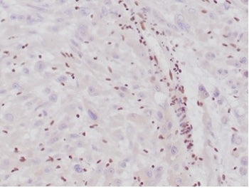 IHC staining of FFPE human epithelioid sarcoma with Integrase interactor 1 antibody (clone SMARCB1/4587R). HIER: boil tissue sections in pH 9 10mM Tris with 1mM EDTA for 20 min and allow to cool before testing.