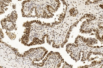 IHC testing of FFPE human ovarian cancer tissue with PCNA antibody. HIER: steam section in pH6 citra