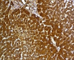 IHC: Formalin-fixed, paraffin-embedded human hepatocellular carcinoma stained with Glypican-3 antibo
