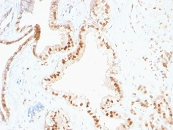 IHC analysis of formalin-fixed, paraffin-embedded human prostate carcinoma stained with p27 antibody