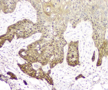 IHC staining of FFPE human esophagus squama cancer with 14-3-3 sigma antibody. HIER: boil tissue sec