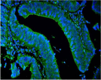 Immunofluorescent staining of FFPE human intestinal cancer with LPP antibody (green) and DAPI nuclea