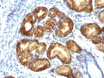 IHC: Formalin-fixed, paraffin-embedded human gastric carcinoma stained with MUC6 antibody (clone CLH