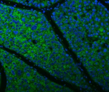 Immunofluorescent staining of FFPE human liver cancer tissue with Citrin antibody (green) and DAPI n