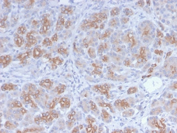 IHC staining of FFPE human breast carcinoma with recombinant Golgi antibody (clone GLG1/2829R). HIER