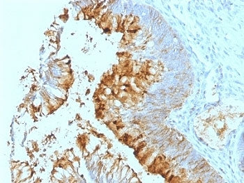 IHC: Formalin-fixed, paraffin-embedded human colon carcinoma stained with Blood Group Lewis a antibo