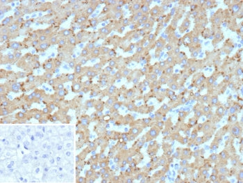 IHC staining of FFPE human hepatocellular carcinoma tissue with HSD17B13 antibody (clone HSD17B13/13