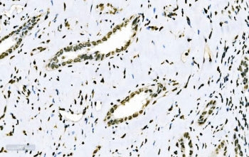 IHC staining of FFPE human squamous metaplasia of the renal pelvis tissue with SF1 antibody. HIER: b