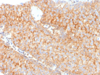 IHC testing of FFPE human urothelial carcinoma with SERBP1 antibody (clone SERBP1/3491). Required HI