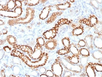 IHC testing of FFPE human renal cell carcinoma with recombinant Cadherin 16 antibody (clone CDH16/15