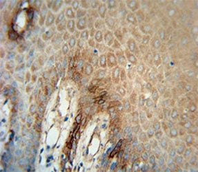 ITGA6 antibody immunohistochemistry analysis in formalin fixed and paraffin embedded human skin carc