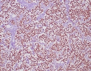 IHC staining of FFPE human seminoma tissue with OCT4 antibody (clone OCT4/6847R) at 2ug/ml. HIER: bo