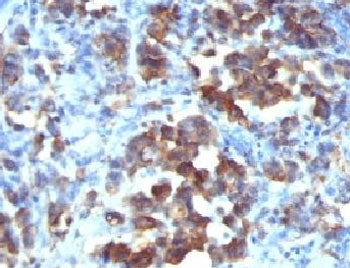 IHC: Formalin-fixed, paraffin-embedded human gastric carcinoma stained with Cdc20 antibody (CDC20/11