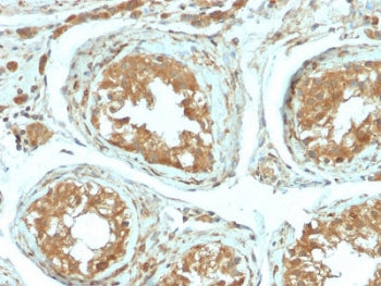 IHC testing of FFPE human testicular carcinoma with recombinant B7-H4 antibody (clone B7H4/2652R). H