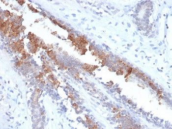 IHC testing of FFPE human breast carcinoma stained with recombinant Mammaglobin antibody (clone MGB/