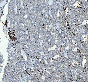 IHC staining of FFPE human thyroid cancer tissue with Integrin beta 3 antibody. HIER: boil tissue se