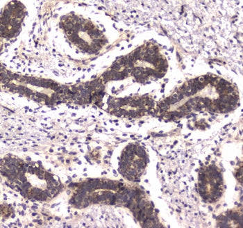 IHC testing of FFPE human breast cancer tissue with POLR2A antibody. HIER: boil tissue sections in p