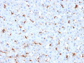 IHC staining of FFPE human hepatocellular carcinoma with C1QB antibody. HIER: boil tissue sections i