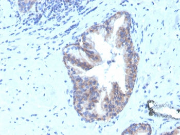 IHC staining of FFPE human prostate carcinoma with biotinylated CD47 antibody (clone CD47/3019). HIE